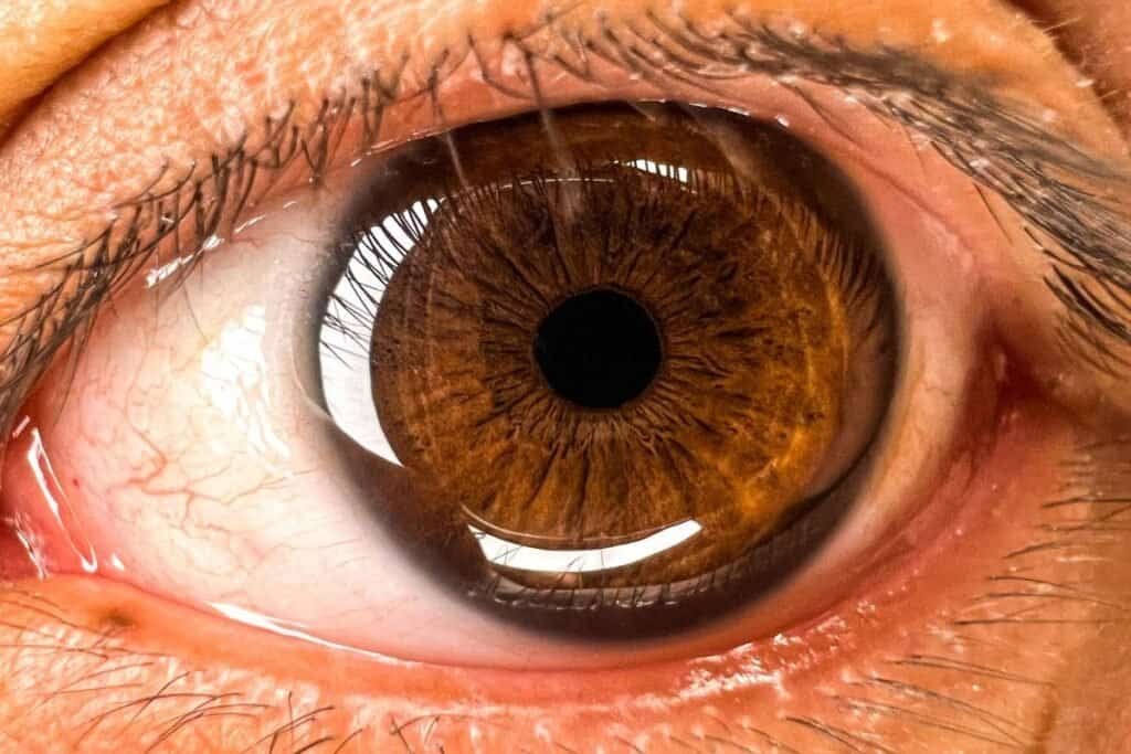 Ilustração anatômica do olho representando os sintomas iniciais do descolamento de retina